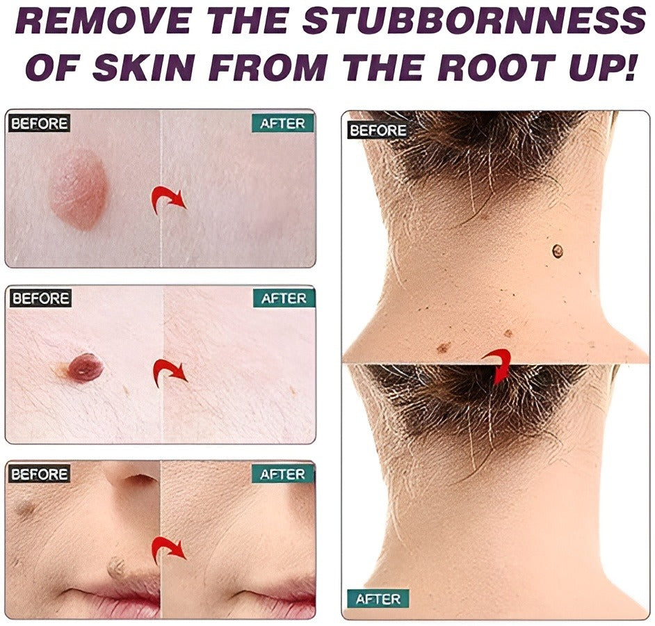 🌿 Crema Eliminadora de Verrugas y Mezquinos