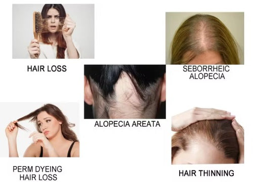 OUHOE Spray para el Crecimiento del Cabello – 30 ml ✨