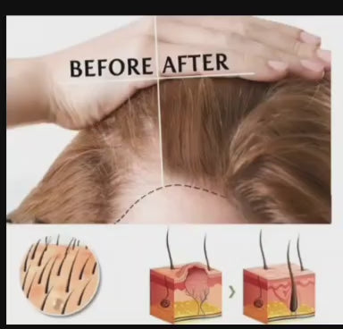 OUHOE Spray para el Crecimiento del Cabello – 30 ml ✨